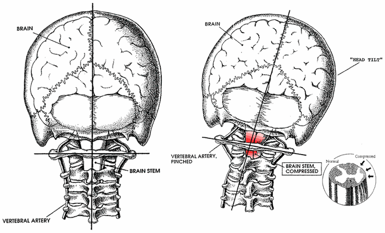 Needham Chiropractor | Needham chiropractic What is Atlas Orthogonal Upper Cervical Care? |  MA |